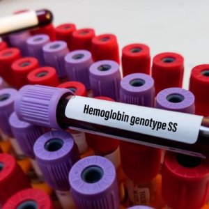 Kadar Hemoglobin Rendah Pasca Lebaran? Ini Cara Mengatasinya