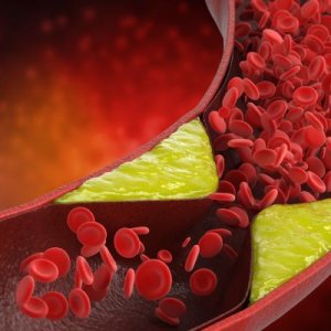 Cegah Penyakit Darah Kental Pasca Lebaran bagi Penderita Kolesterol