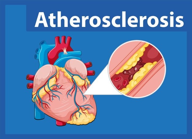 Aterosklerosis adalah salah satu penyakit dalam sistem peredaran darah