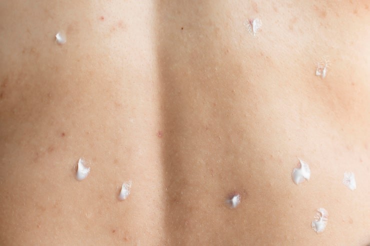 Diagnosa kusta dengan skin smear