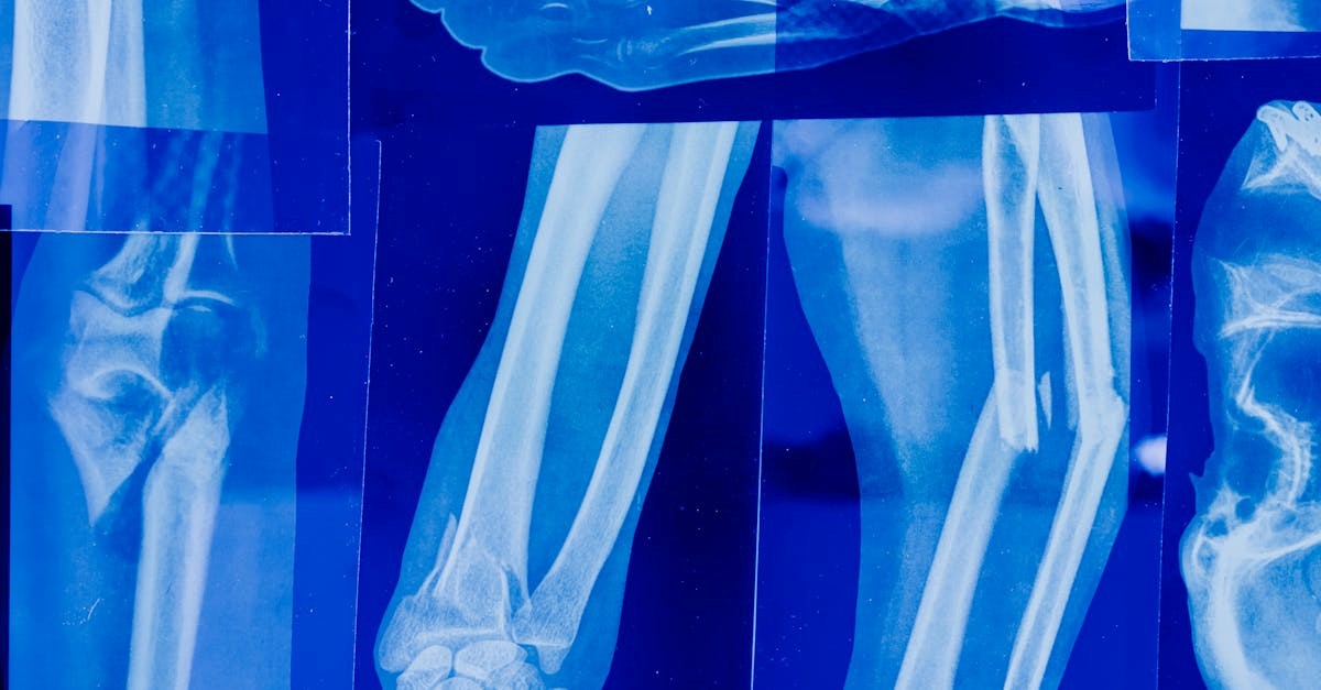 Hasil X-ray patah tulang