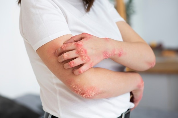 Ruam sebagai gejala penyakit lupus