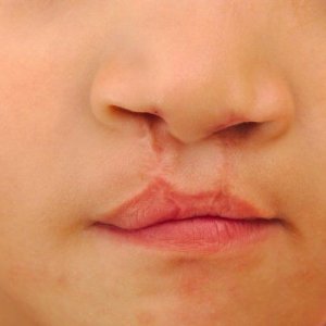 Bibir Sumbing dan Risikonya pada Bayi