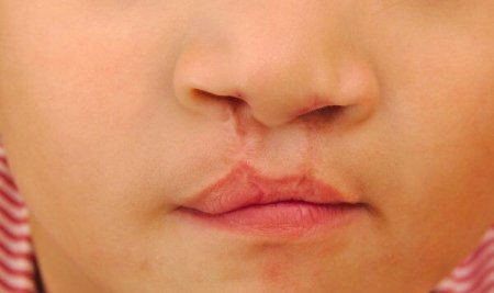 Bibir Sumbing dan Risikonya pada Bayi