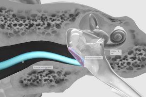 Ilustrasi gendang telinga.