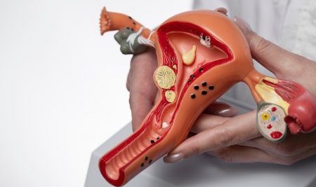 Kista Ovarium: Gejala yang Diam-Diam Mengganggu Kesuburan