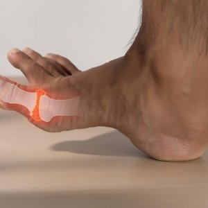 Asam Urat dan Air Putih, Apa Hubungannya?