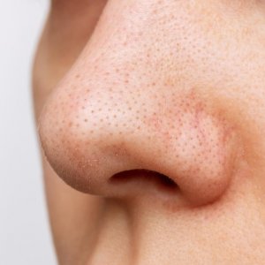 Pori-Pori Wajah: Kesalahan Perawatan yang Harus Dihindari