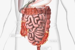 Infografis penyakit radang usus.