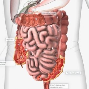 Radang Usus: Gejala yang Harus Diwaspadai
