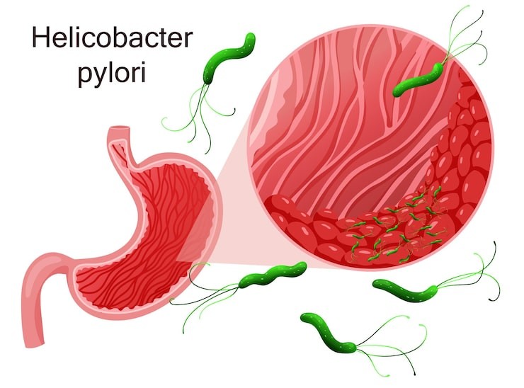 Bakteri Helicobacter pylori salah satu penyebab sakit ulu hati.