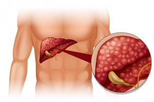 Ilustrasi batu empedu apakah berbahaya.