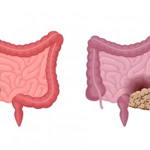 Tips Membersihkan Usus Kotor yang Mudah