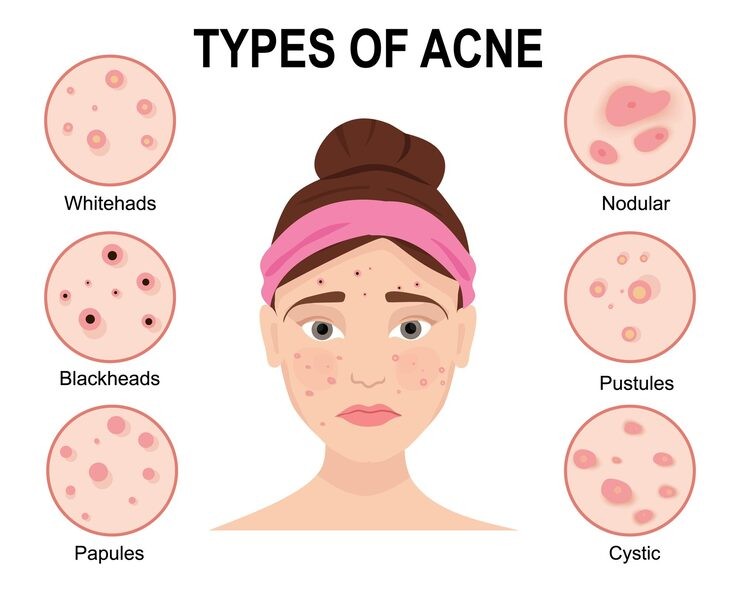 Berbagai jenis jerawat.