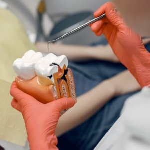 Gigi Berlubang? Begini Cara Mencegahnya