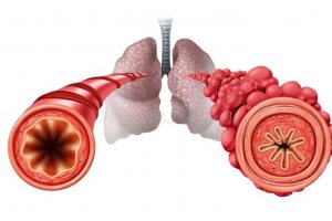 Ilustrasi popcorn lung.