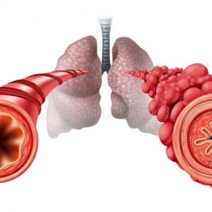 Apa Itu Popcorn Lung dan Apa Penyebabnya?
