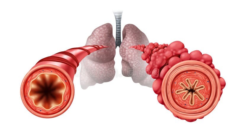 Ilustrasi popcorn lung.