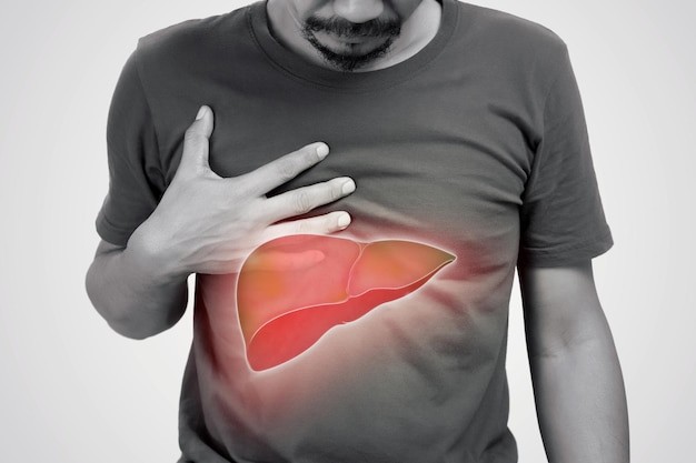Ilustrasi fatty liver.