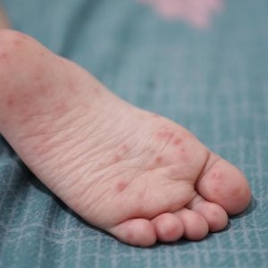Virus Singapura dan Gejalanya